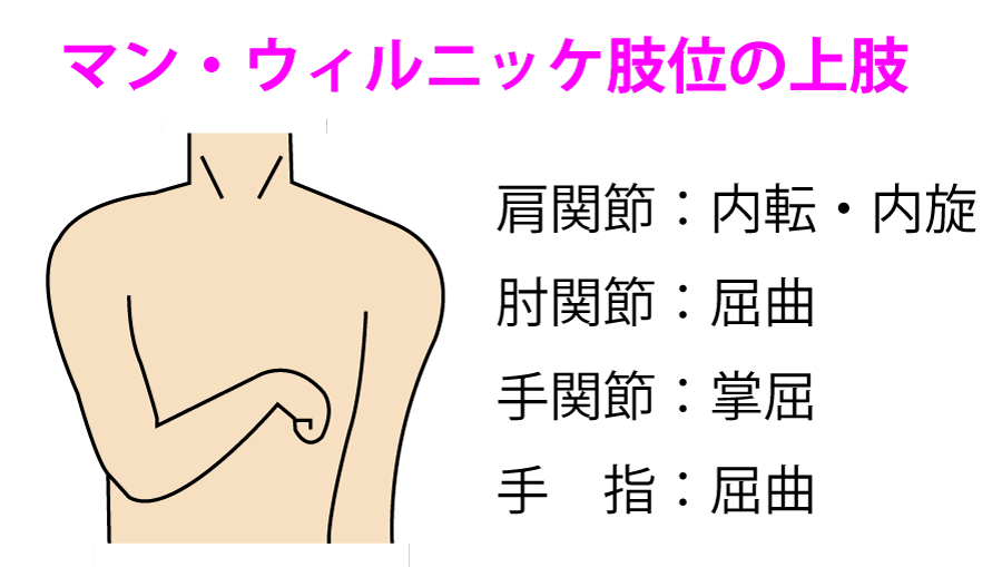 マン・ウェルニッケ肢位にある片麻痺患者に対して、上肢の痙性の改善を目的に相反性Ⅰa抑制を応用した低周波鍼通電療法を行う場合、適切な治療穴の組合せはどれか（30回）