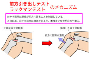 ラックマンテスト・前方引き出しテスト【膝関節の検査】