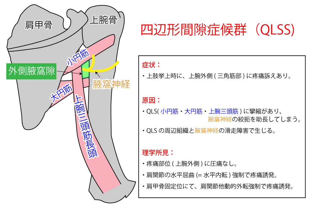 イラスト解説 外側腋窩隙 Qls クアドリラテラルスペース 内側腋窩隙 上腕三頭筋裂孔 の位置 構成組織